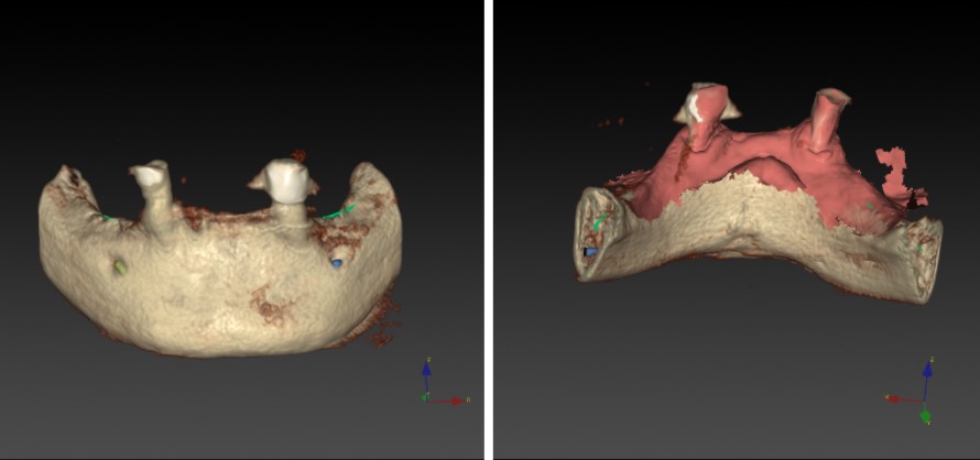 Tomografía computerizada para implante dental